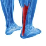 Achilled Tendonitits | Achilles Pain | Osteopathy Kew