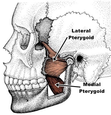 pterygoid headache | TMJ dysfunction