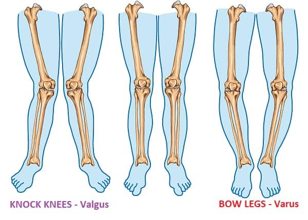 Knock Knees | Valgus Knee | Bow Legs | Varus Knees