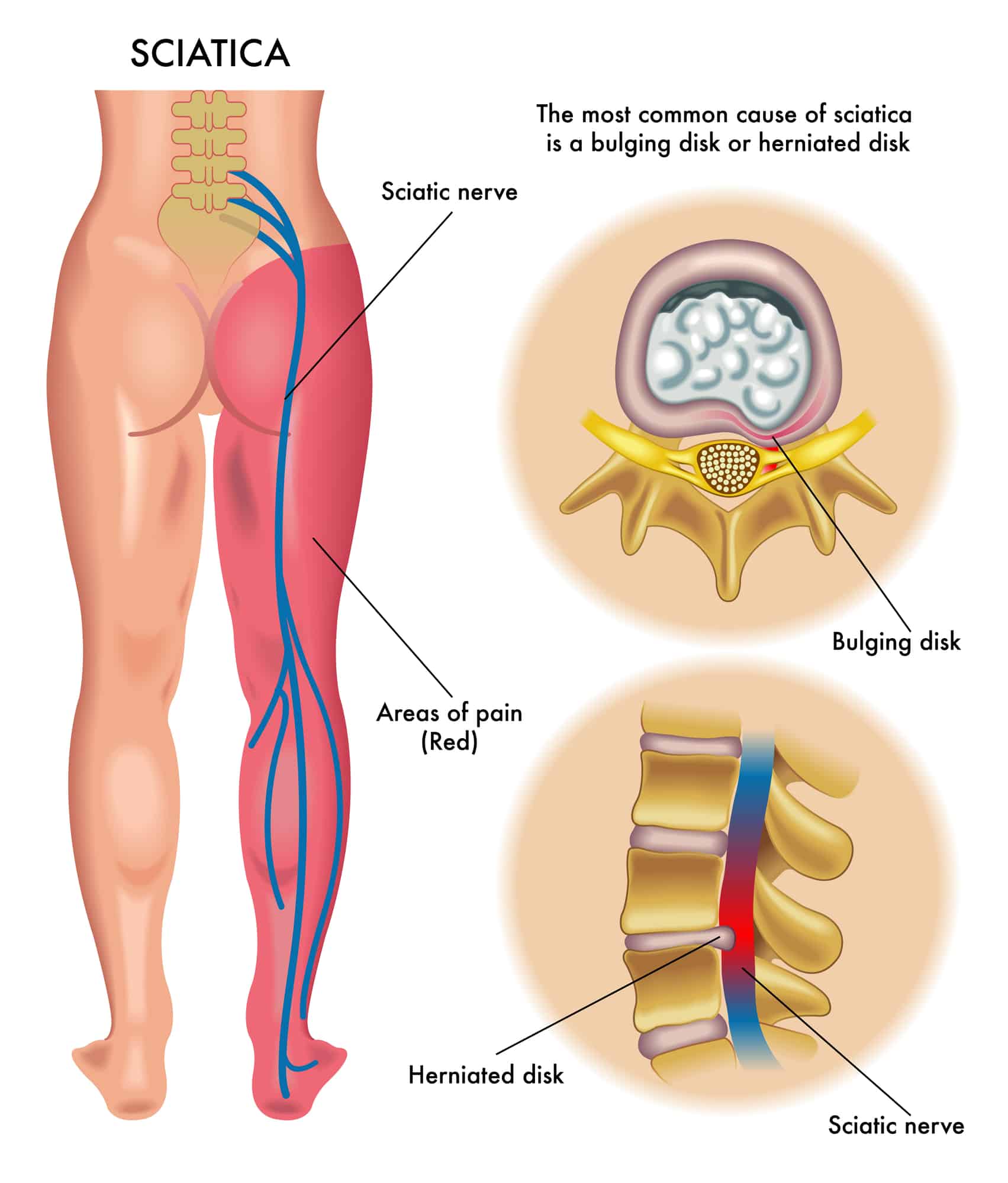 Sciatica | disc injury | disc and MRI |disc bulge