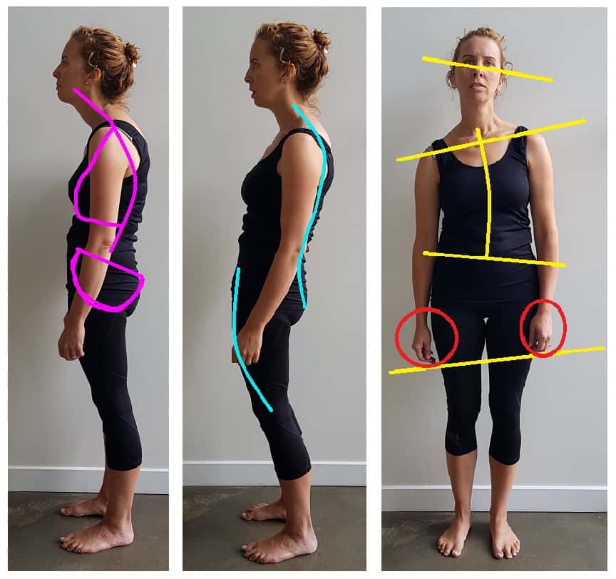 Posture | scoliosis | poor posture