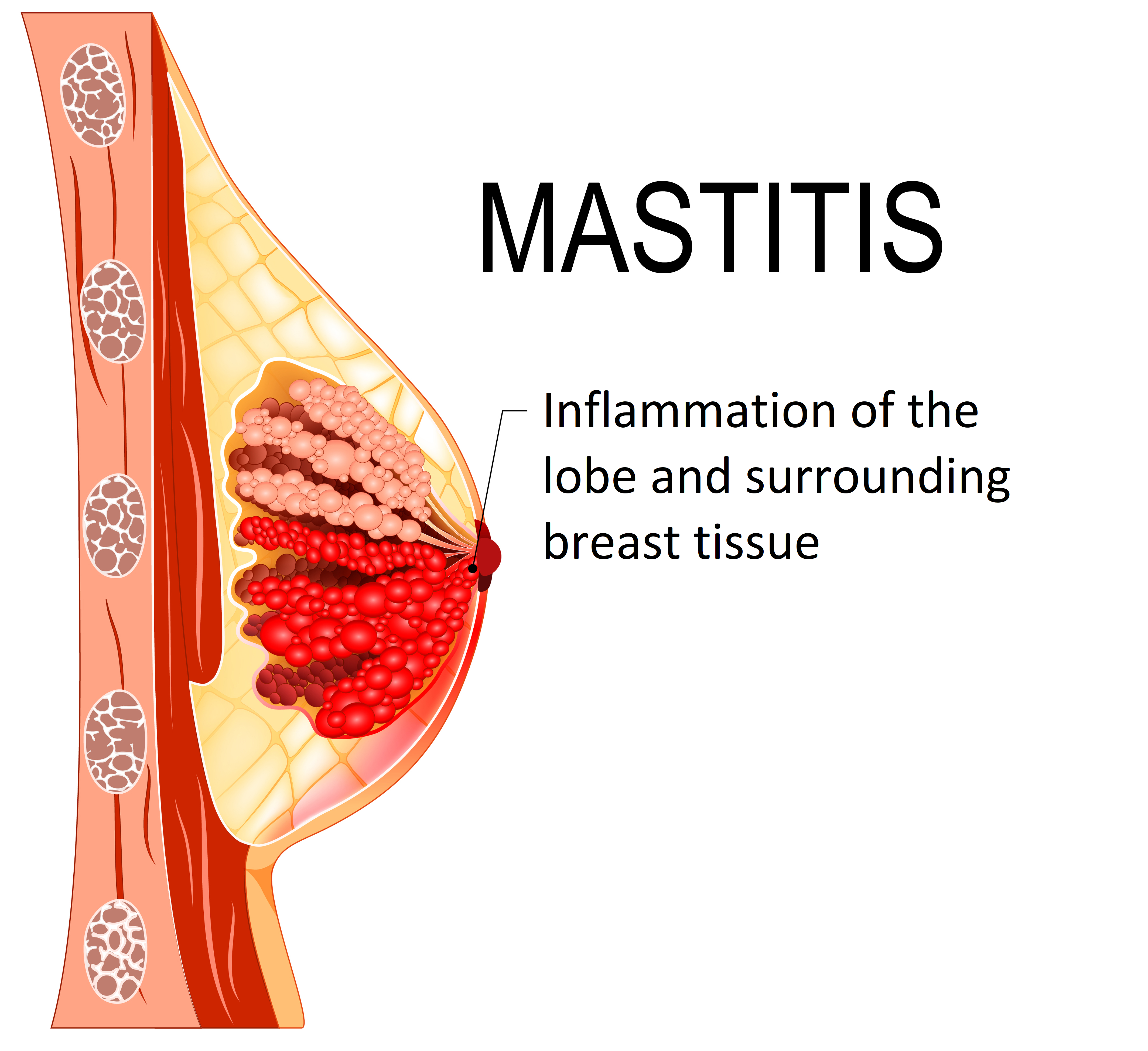 mastitis infection | mastitis inflammation | what causes mastitis