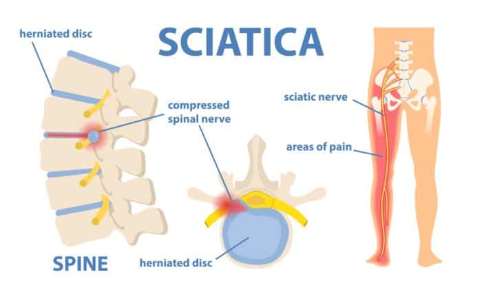 sciatica | sciatic pain | sciatic nerve
