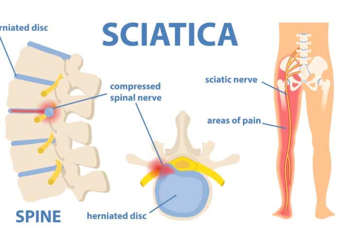 sciatica | sciatic pain | sciatic nerve