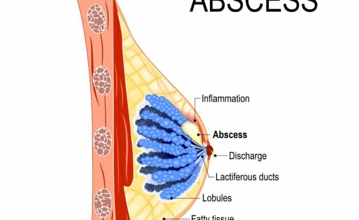 mastitis abscess | breast abscess | abscess and mastitis