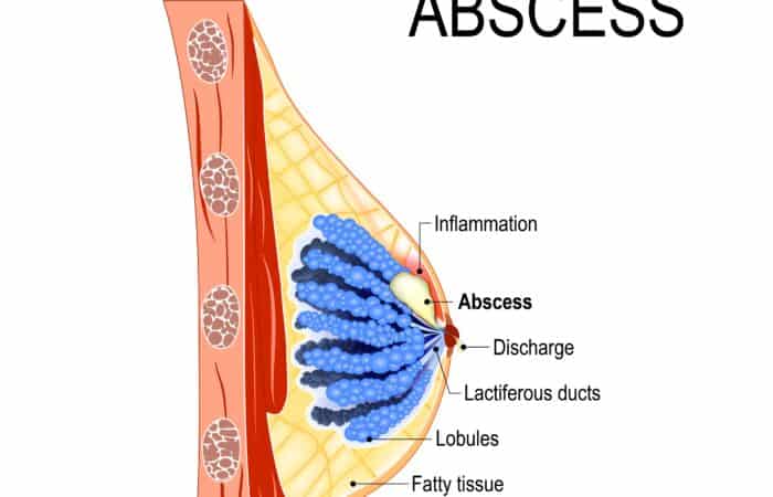 mastitis abscess | breast abscess | abscess and mastitis
