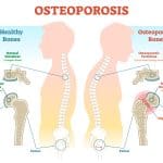 picture of osteoporosis