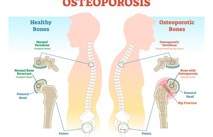 picture of osteoporosis