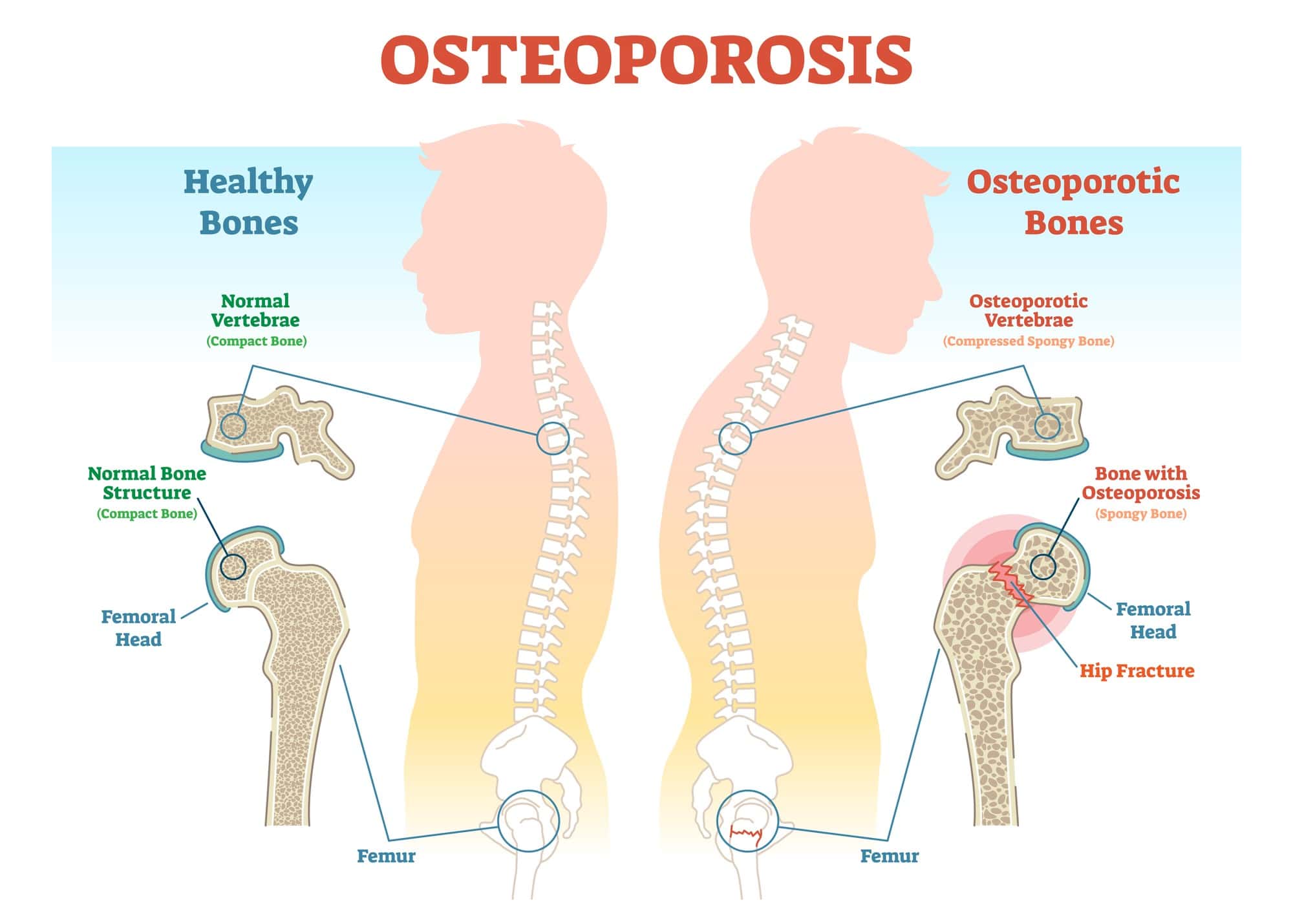 picture of osteoporosis